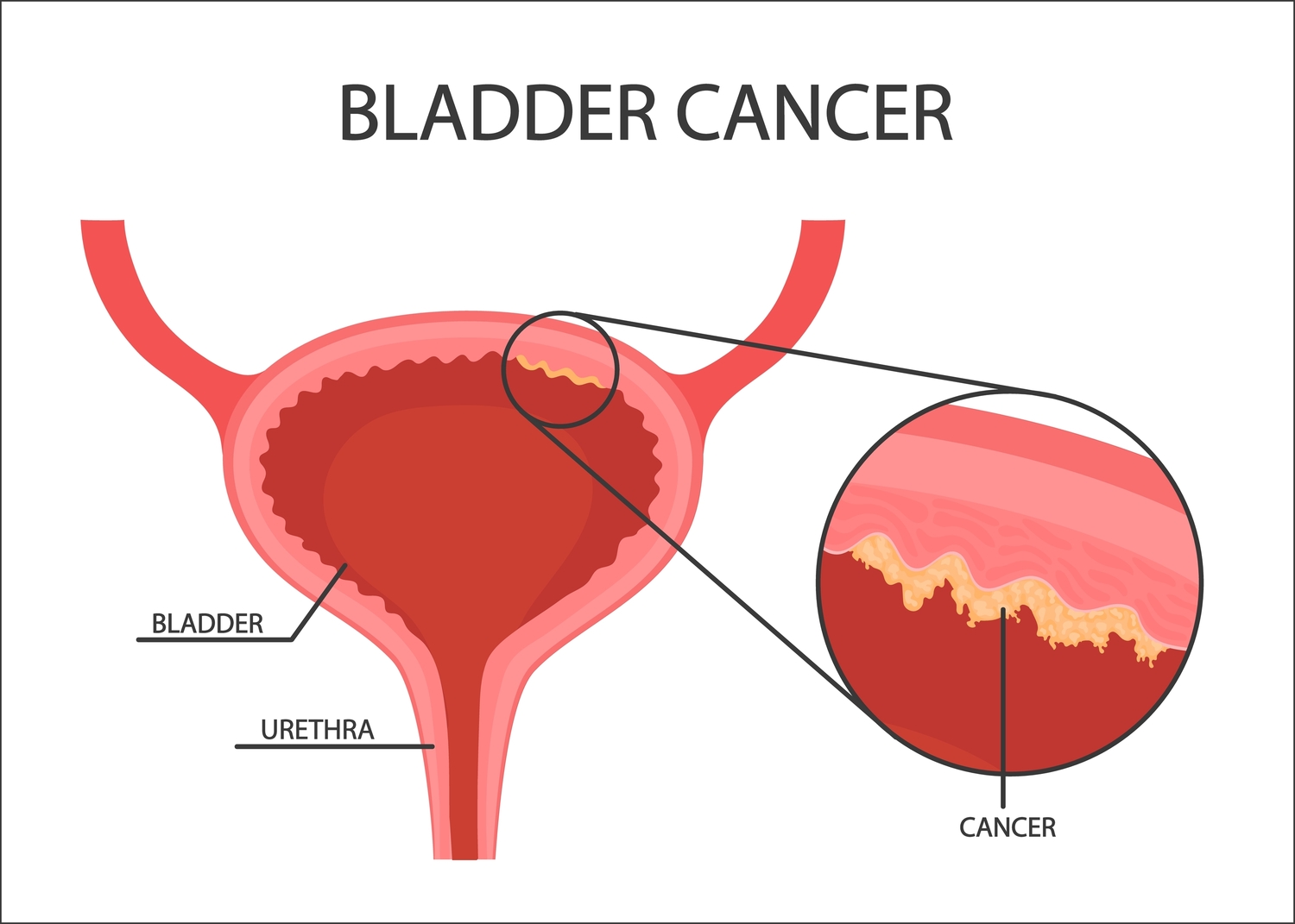 5 Early Warning Signs of Bladder Cancer